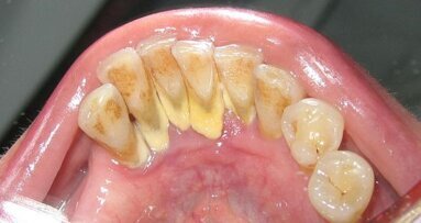 Kamień nazębny – problem poważny i wciąż ignorowany