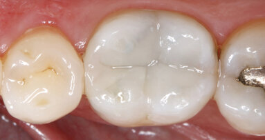 Nano-hybrid ORMOCER  for the bulk-fill technique in the posterior region