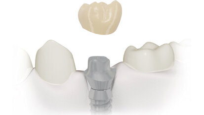 Realizzazione di un abutment implantare customizzato mediante CAD/CAM. Una soluzione specifica per ogni caso clinico