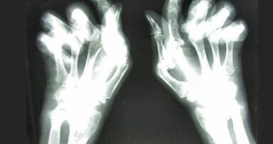 RZS wpływa na stan zdrowia dziąseł