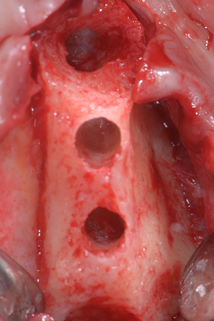 Fig. 5 - Visualizzazione macroscopica delle porzioni apicali dei siti osteotomici preparati con Densah kit. Si intravede la membrana di Schneider intatta.