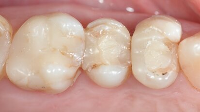 Applicazione di due corone adiacenti con un risultato altamente estetico utilizzando un flusso di lavoro digitale