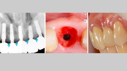 Resultados a largo plazo de una implantología simple