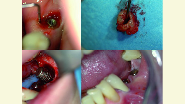 Implantologie et lasers