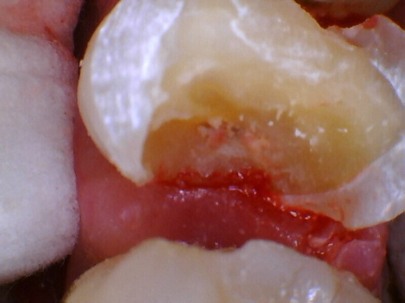 Fig. 5: Small pulpal exposure noted mesially after careful excavation of the affected dentine.