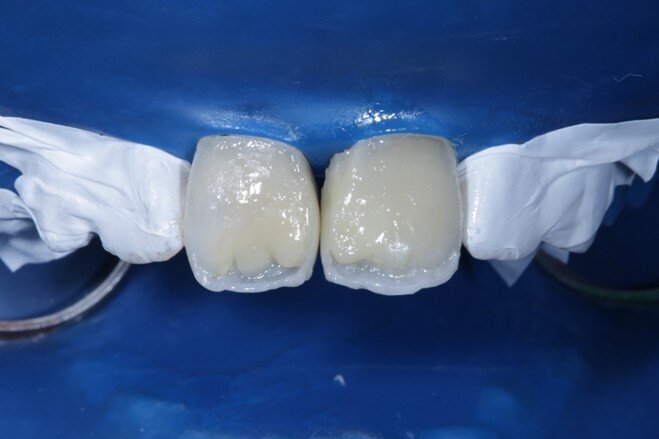 Fig 12 Dark dentin shade layered