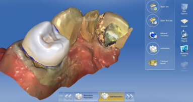 Webinar: Expert introduces design techniques for anterior restorations