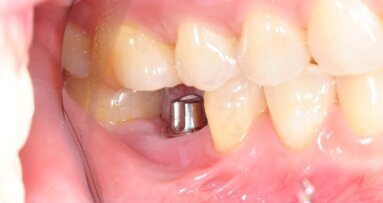 Inžinjeri razvili novi gel koji pouspješuje rast kosti oko zubnih implantata