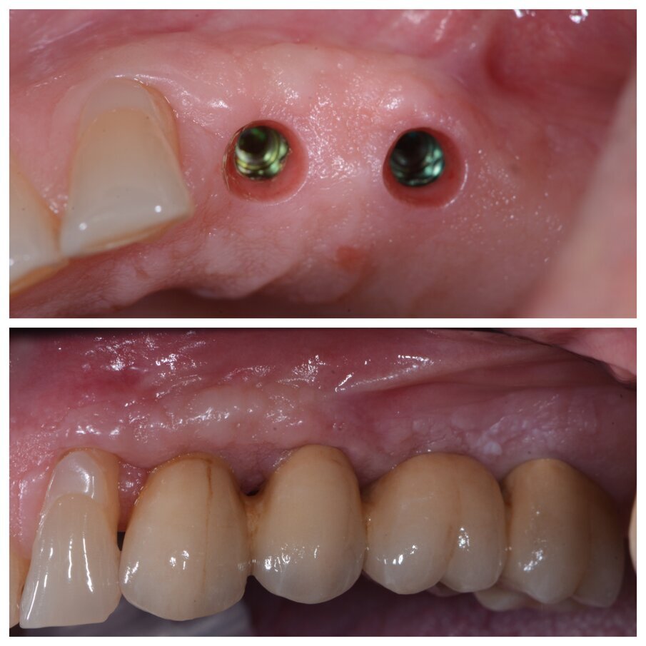 Fig. 2d_Guarigione dei tessuti molli e protesi definitiva.
