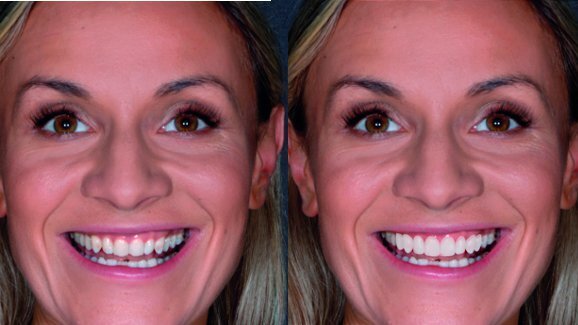 Utilising smile design software and CAD/CAM for creating a mock-up and final restorations