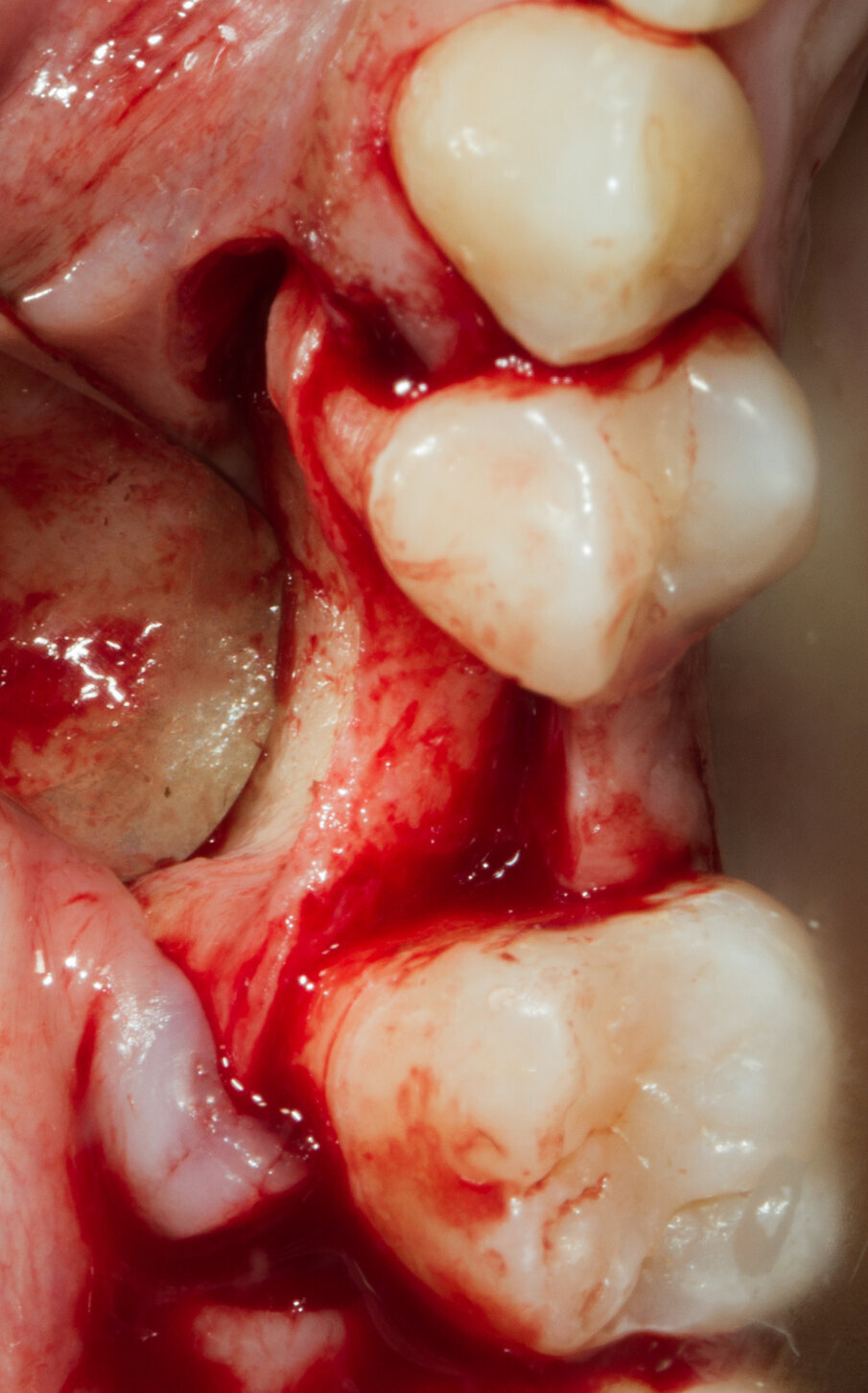Fig. 6 - Visione crestale del difetto osseo.