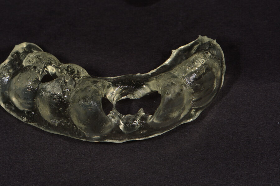 Fig. 10: Same surgical guide after rinsing and polymerising.