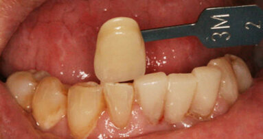 Three-unit, full-contour ceramic bridge in one sitting