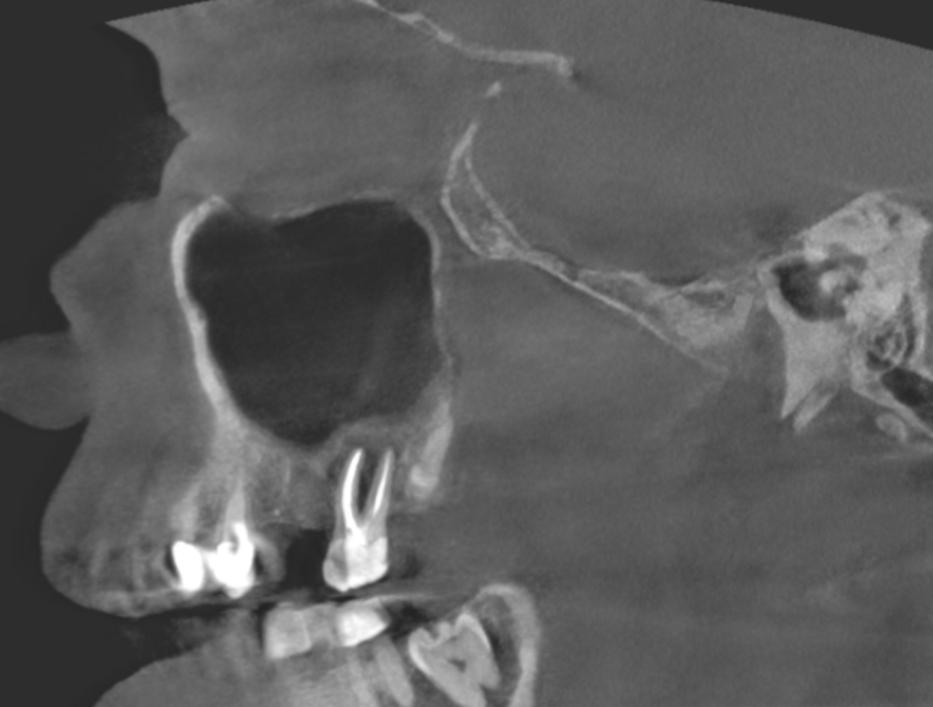 Fig. 8a: Large-volume CBCT scan, sagittal cross-section of the buccal roots showing full recovery of the periapical bone (a).