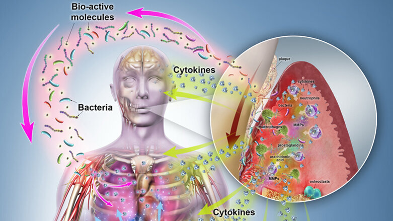 Zánět tkání parodontu – zjednodušeně