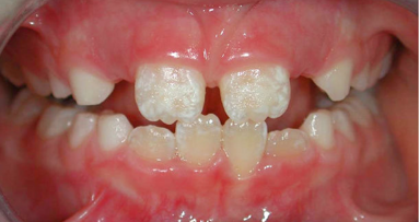 Липсата на естествено хранене може да предразположи децата към емайлови дисплазии