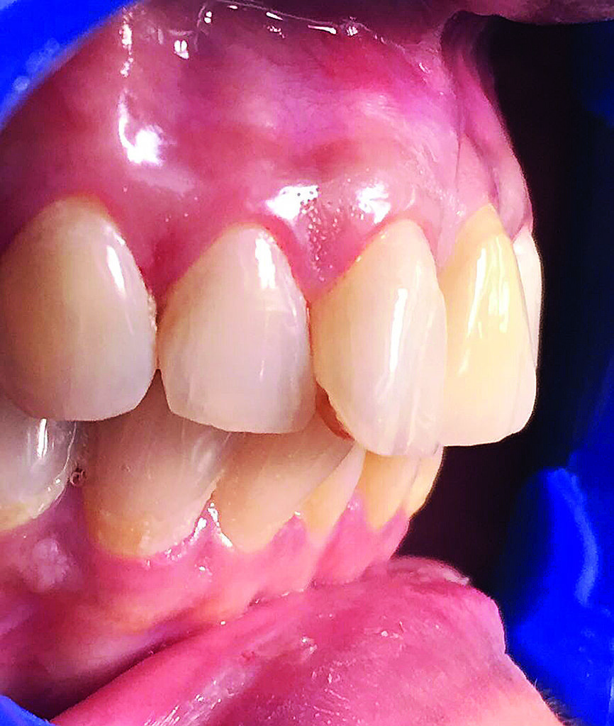 Fig. 6a  :
Situation postopératoire et radiographie après un an.
