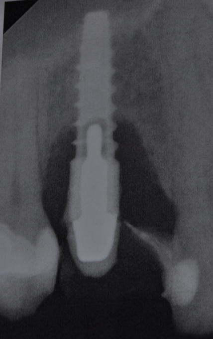 Fig.3: Case 1. X-ray testifying severe peri-implant CBL.
