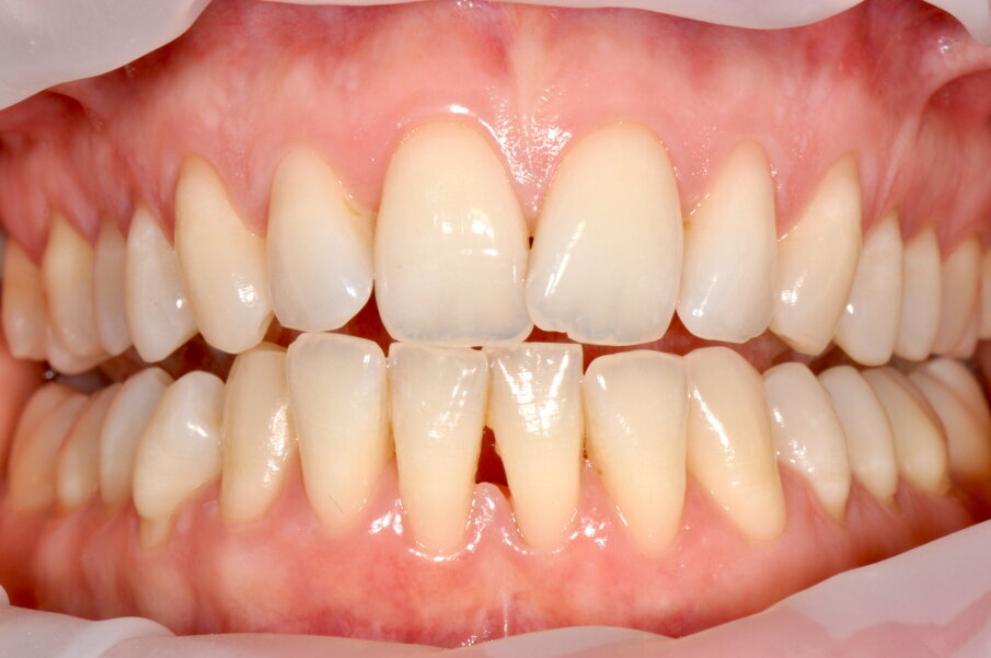 Figg. 6a-6d - Confronto fra stato iniziale e alla valutazione a 2 settimane (6a, 6c), il rilevatore di placca (6b, 6d) mostra chiaramente il miglioramento della compliance del paziente.