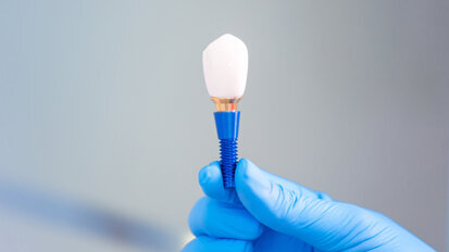 Dental implants show longevity and continued function after four decades
