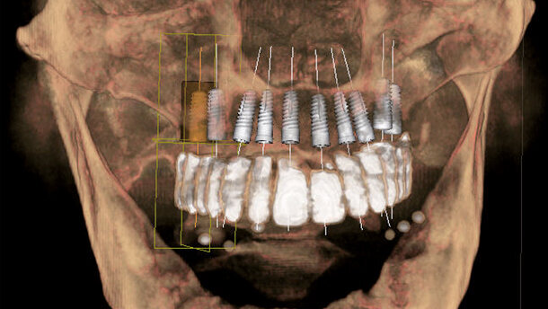 Vantaggi della progettazione implantare in 3D