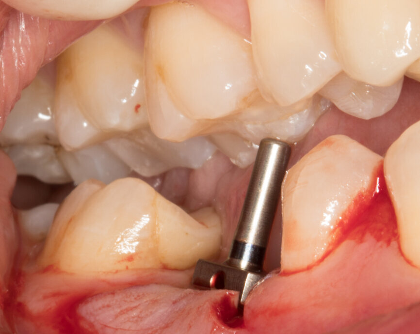 Ryc. 7 i 8_Osadzenie znacznika celem potwierdzenia pozycji przyszłego wszczepu.