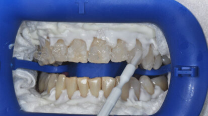 Sbiancamento professionale alla poltrona e combinato: case series