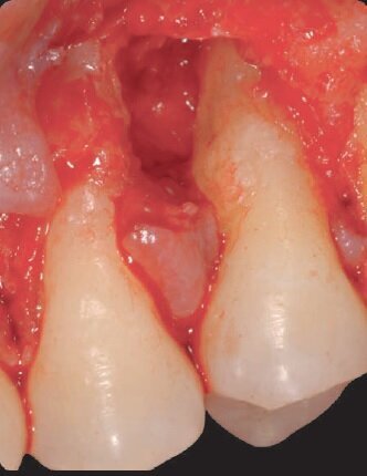 Fig. 3 - Incisone e lembo scollato.