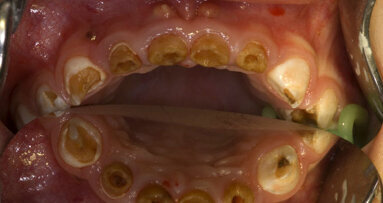 Narkose bei schwerer Kinderkaries wieder planbar