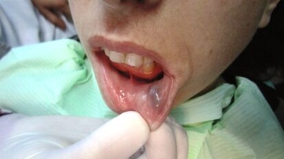 Leczenie naczyniowych schorzeń ust z zastosowaniem lasera