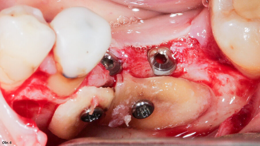 Kořeny byly vytvarovány tak, aby pasovaly do místa defektu a jsou
v místě transplantace zajištěny osteosyntetickými šroubky.