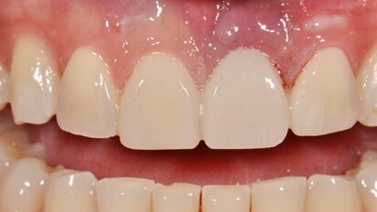 Bridge provisoire direct collé à la résine et élément de bridge composite avec bande de fibres de verre imprégnée de résine