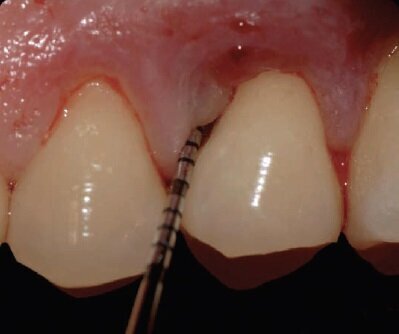 Fig. 2a - Sondaggio clinico iniziale.