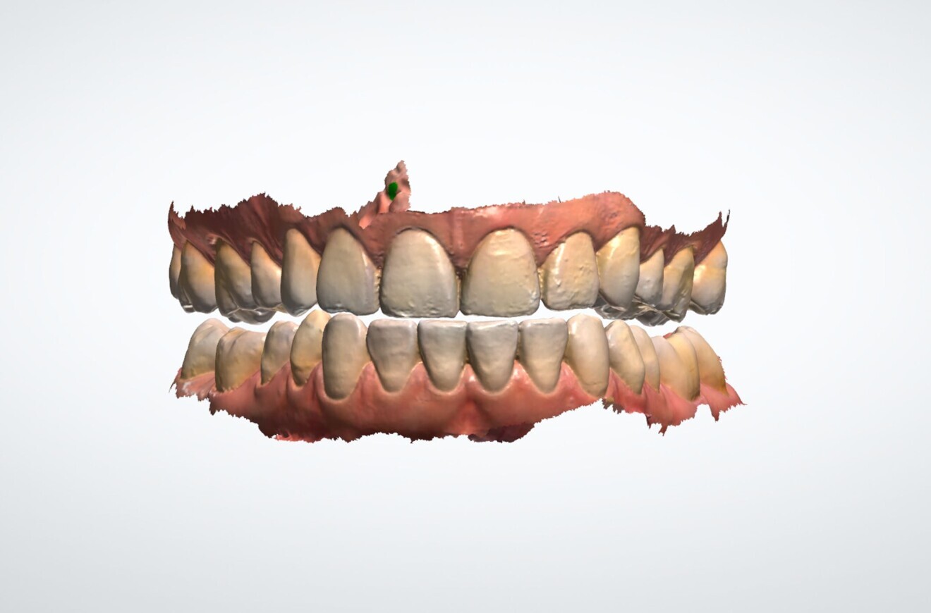 Fig. 2: Intra-oral scan on the screen.