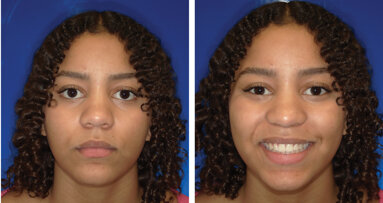 Unilateral Class II correction in less than a year using leading edge aligners