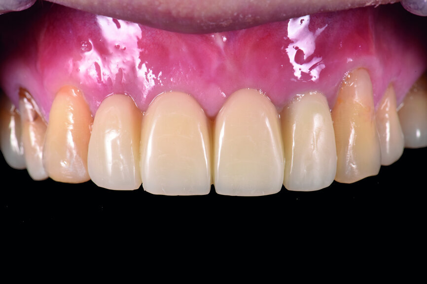 Fig. 21: Frontal view of the anterior teeth after adjustment of the labial contour of tooth #13.