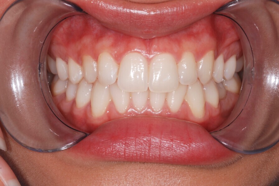 Fig. 12: Intra-oral view with the teeth in occlusion after treatment.