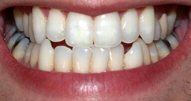 Rješenje za škripanje sa zubima