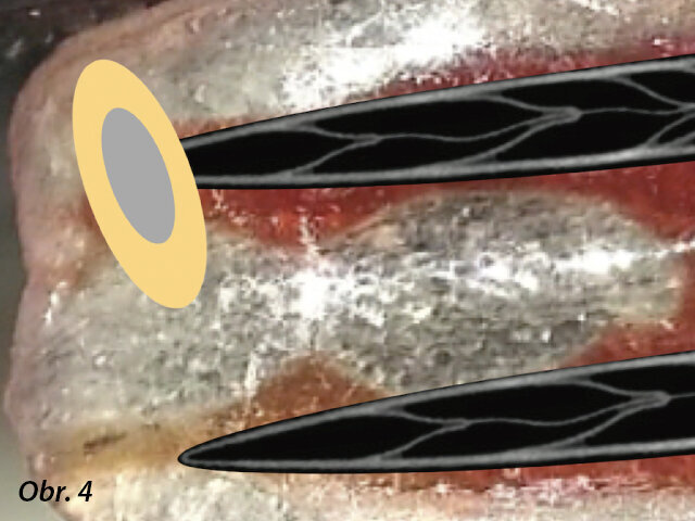 Ideální nástroj by při preparaci apikálně respektoval trojrozměrnost prostoru a provedl vyčištění za udržení minimálního apikálního otvoru. SAF je dutý nástroj navržený jako elasticky stlačitelný, tenkostěnný špičatý válec, který je složen z NiTi mřížky.