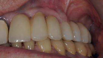 Soulevé de sinus et ostéotenseur : le Fractal lift