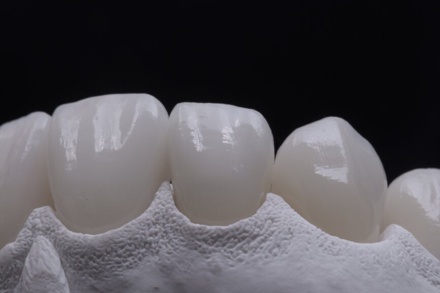 Fig. 74: Glazed ceramic veneers on the plaster model.