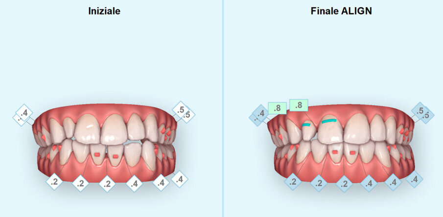 Fig. 3 - ClinCheck trattamanto Invisalign pre e post visioni frontale, si osservi la corretta gestione degli spazi in senso mesio-distale.