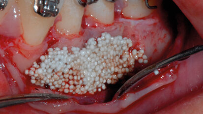 Utilizzo di un innovativo  materiale da innesto nel movimento ortodontico parodontalmente accelerato