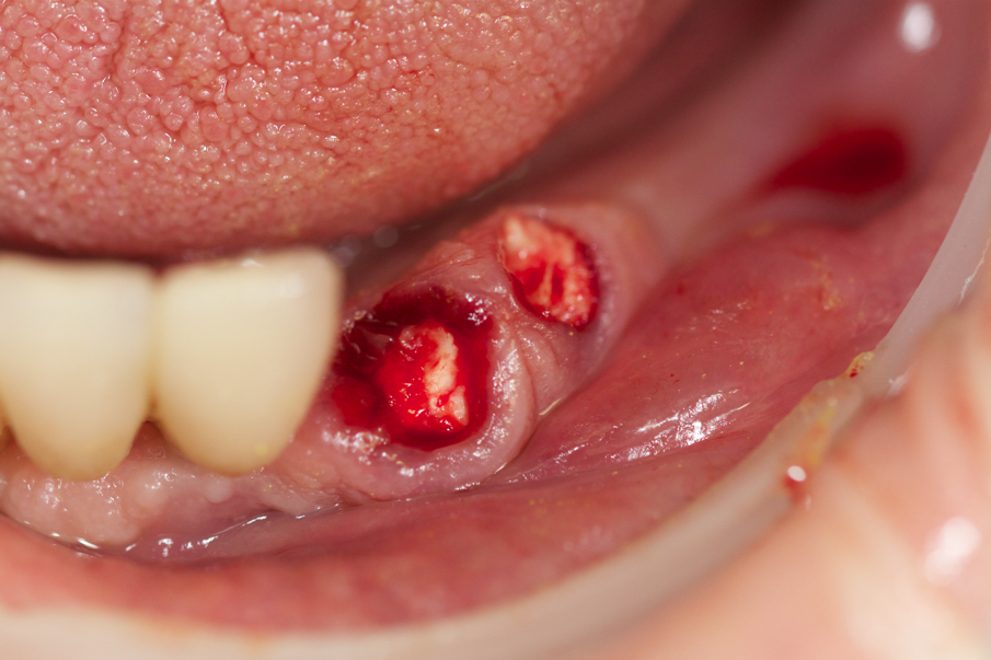 Fig. 14 - Spugne emostatiche (Hemocollagene, Septodont) sono state inserite nei siti di estrazione.
