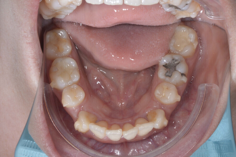 Fig. 5: Showing maximum anchorage planned for this case.