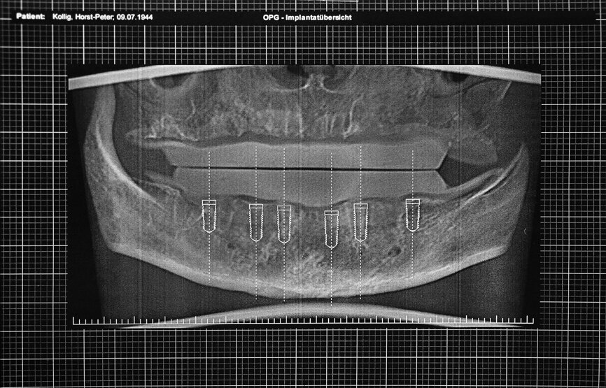 Figs. 12a et b : Tomographie panoramique dentaire virtuelle montrant les positions des implants numériquement définies en 3D dans le maxillaire (a) et la mandibule (b). 