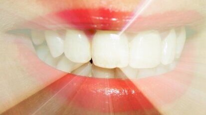 Prawdy i mity o wybielaniu zębów