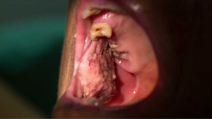 Kryzys COVID-19 może negatywnie wpłynąć na wykrywalność nowotworów jamy ustnej