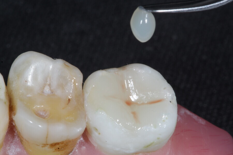 Fig. 33: The final occlusal layer of the restoration is placed using an enamel supra-nano hybrid composite in Shade A2 (Estelite).