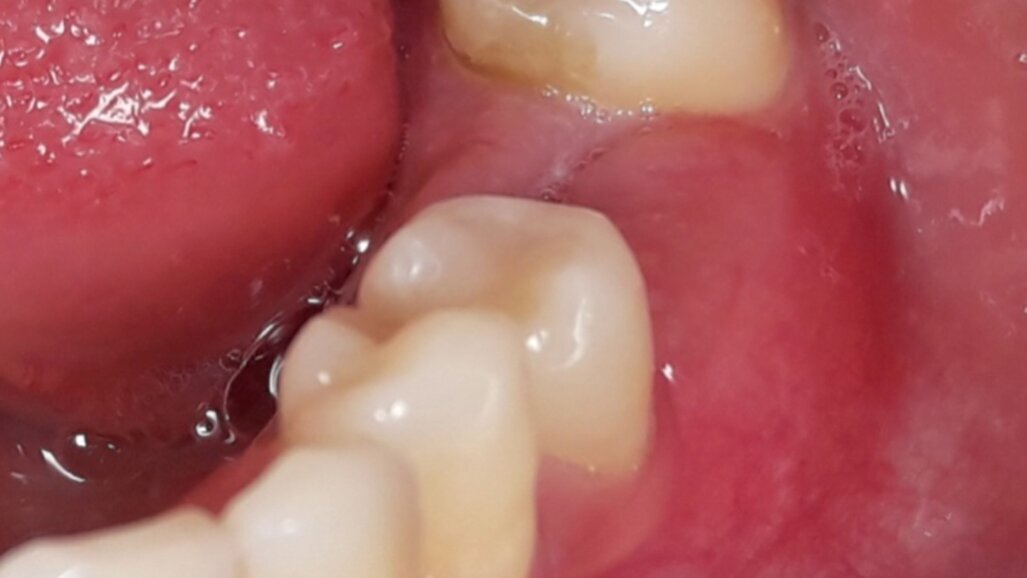 Incremento volumetrico dei tessuti molli sovracrestali in implantoprotesi mediante la tecnica “M.T.G”.